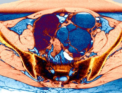 Endometriosis, a condition in which uterine cells form lesions outside of the uterus, has been termed the ‘missed disease’ owing to its unknown cause, delays in diagnosis and disparities in treatment.Credit: Zephyr/Science Photo Library