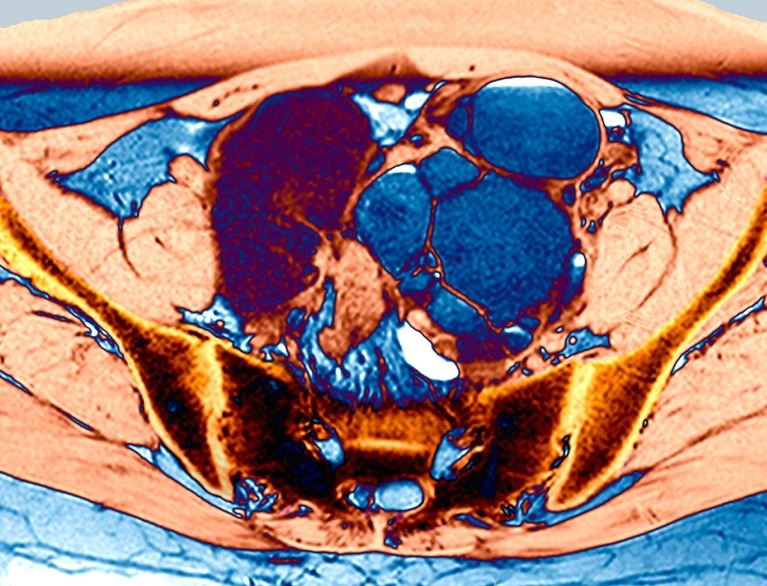 Endometriosis, a condition in which uterine cells form lesions outside of the uterus, has been termed the ‘missed disease’ owing to its unknown cause, delays in diagnosis and disparities in treatment.Credit: Zephyr/Science Photo Library